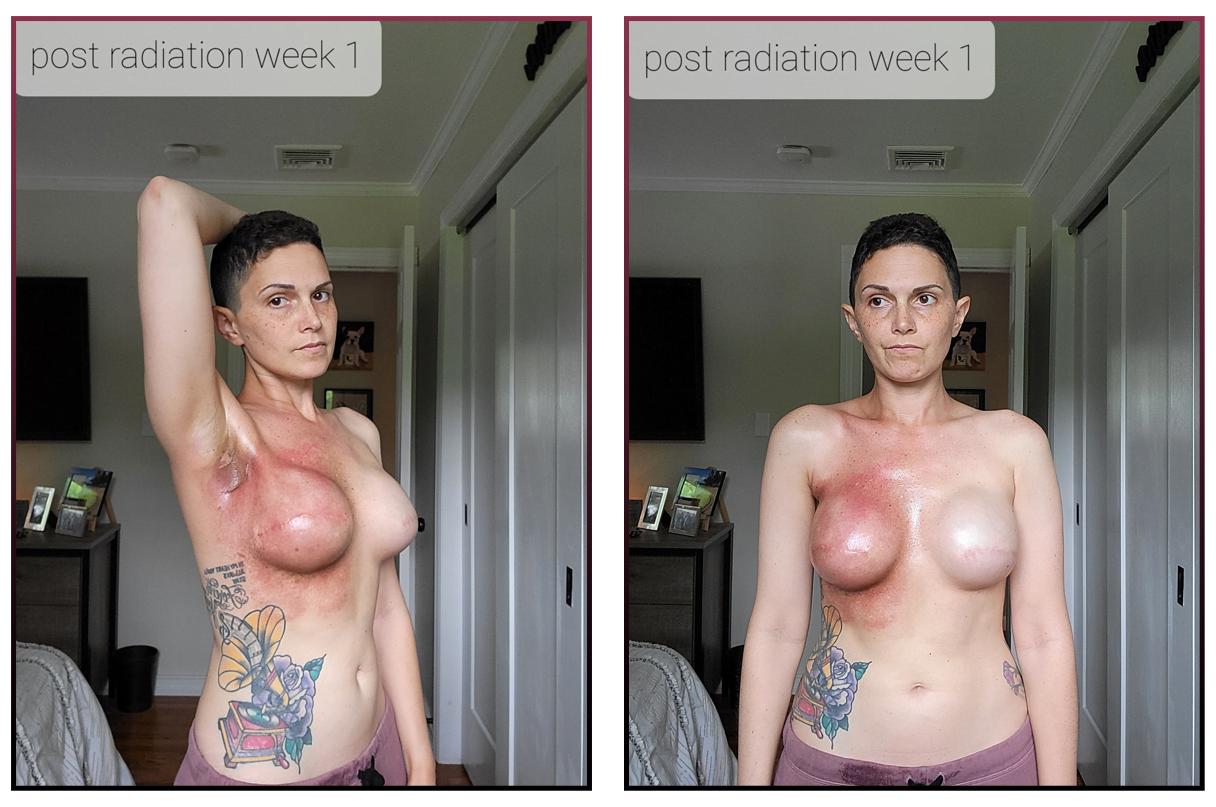 radiation burns, breast cancer radiation, radiation treatment