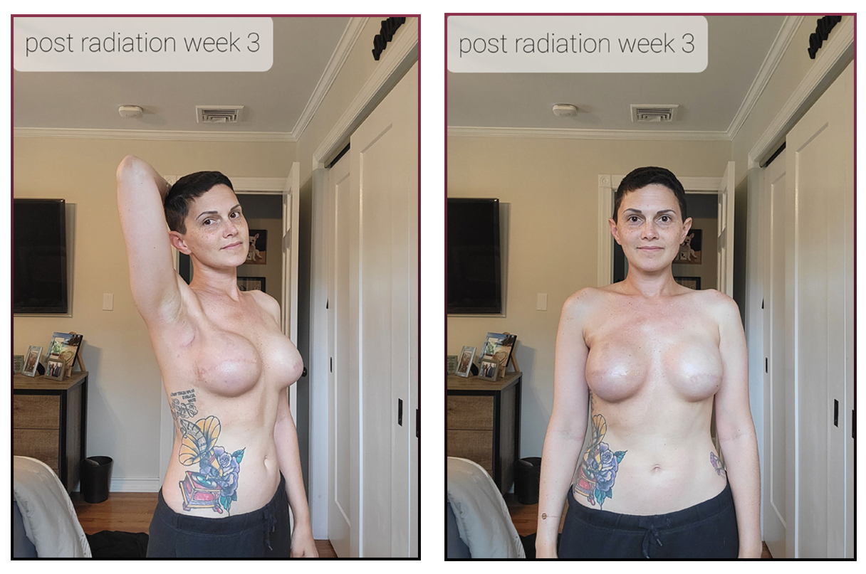 radiation burns, breast cancer radiation, radiation treatment